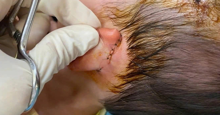 Bé gái bị chó cắn ở Huế được cứu sống