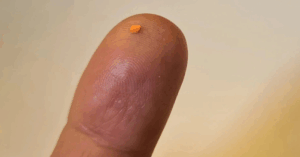 Công nghệ chip 2mm khôi phục ánh sáng cho người mù