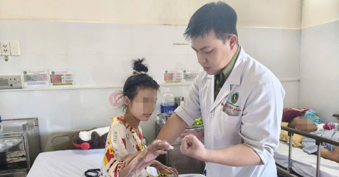 Tai nạn keo nến khiến nữ sinh bỏng 48% cơ thể