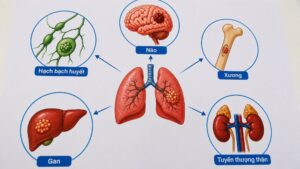 Ung thư phổi có thể di căn đến não, xương, gan và nhiều cơ quan khác. Tìm hiểu các vị trí di căn thường gặp.